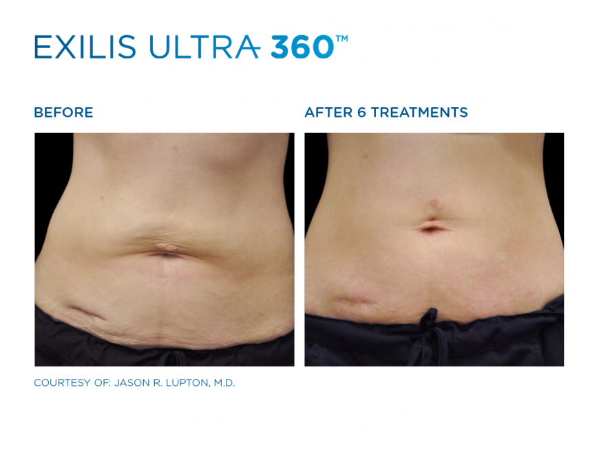 BTL Exilis treatment in Dubai